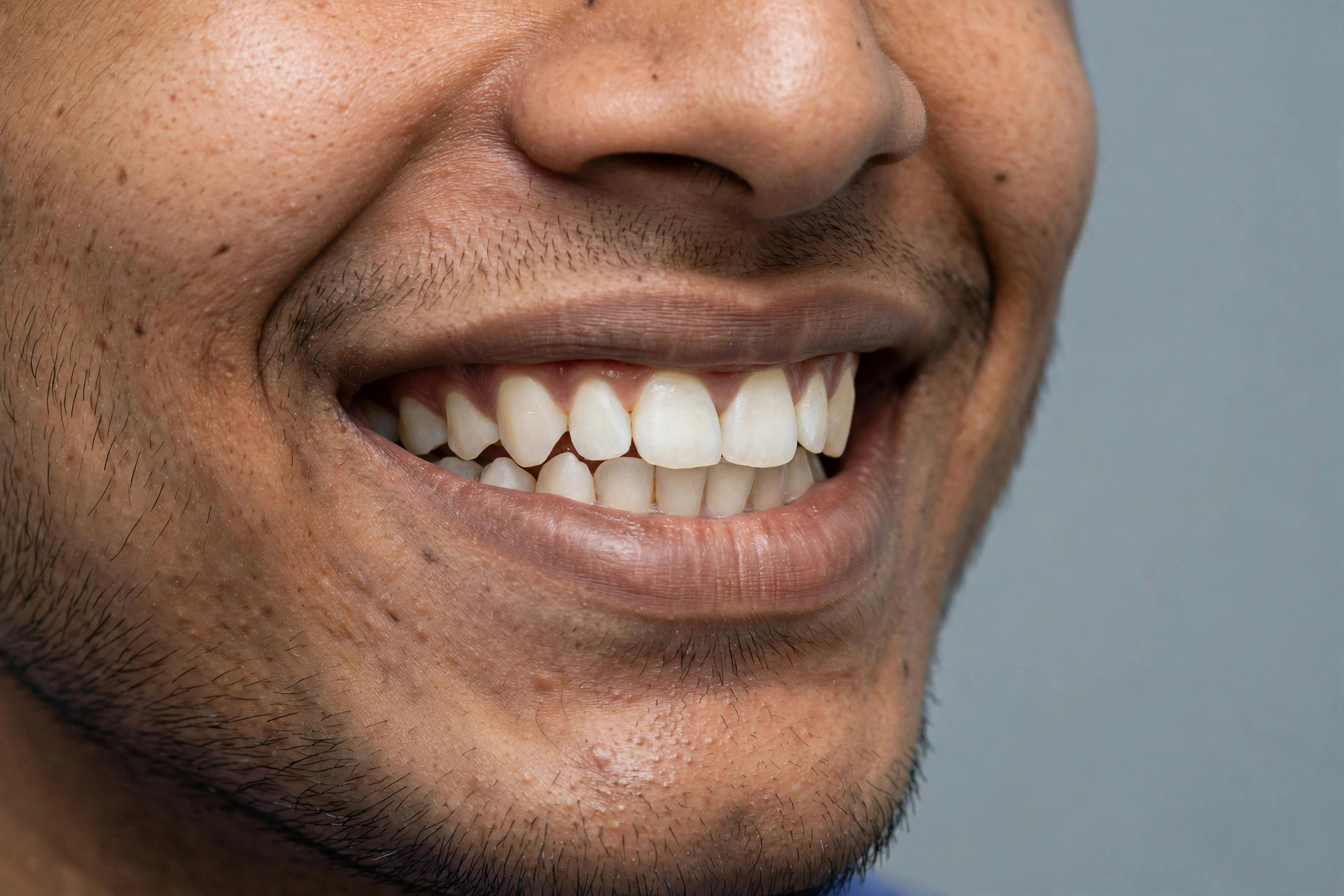 Teeth after braces